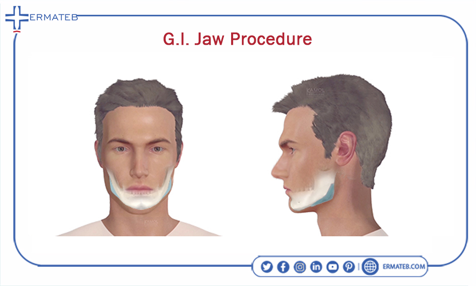 G.I jaw procedure